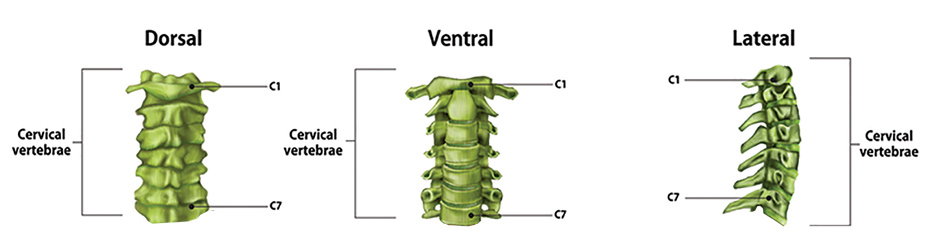 Realignment of the cervical spine