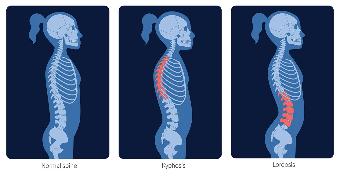 Shape comparison between normal spine, Kyphosis and Lordosis